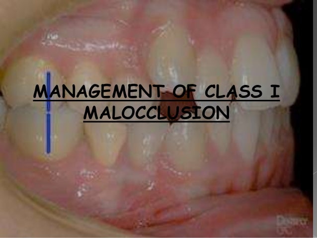 Management Of Class I Malocclusion Management Of Class I Malocclusion