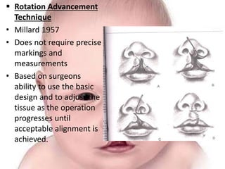 Management of cleft lip and palate | PPTX