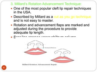 Management of cleft lip and palate | PPTX
