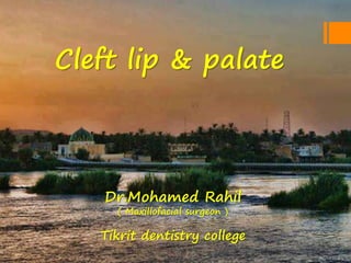 Cleft lip & palate
Dr.Mohamed Rahil
( Maxillofacial surgeon )
Tikrit dentistry college
 