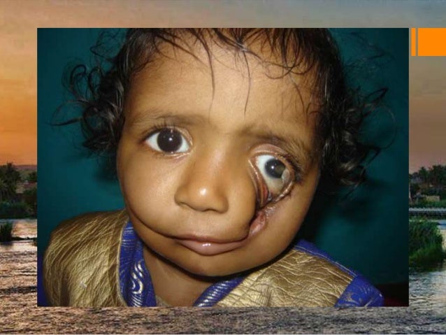 management of cleft lip palate cleft lip repair