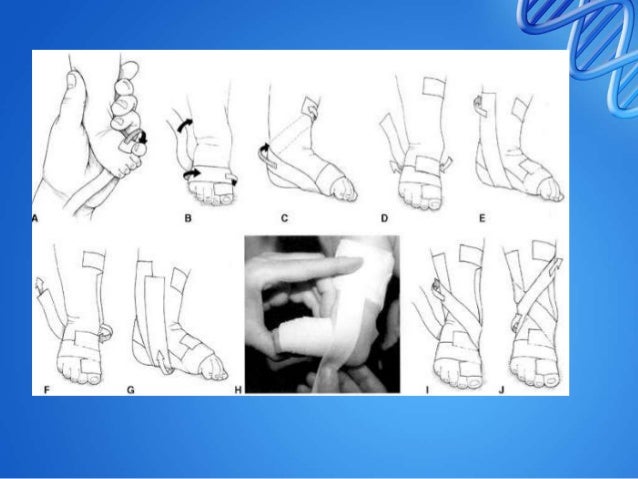 Management of club foot