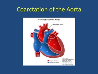 Coarctation of the Aorta 