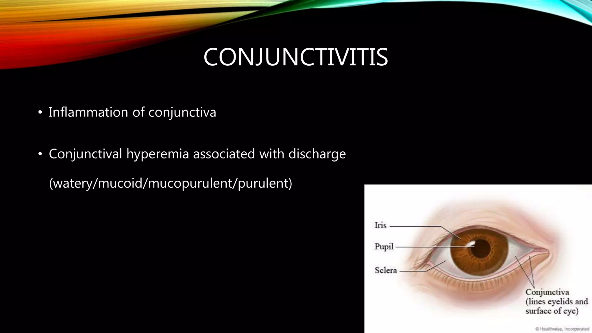 CONJUNCTIVITIS
• Inflammation of conjunctiva
• Conjunctival hyperemia associated with discharge
(watery/mucoid/mucopurulent/purulent)
 