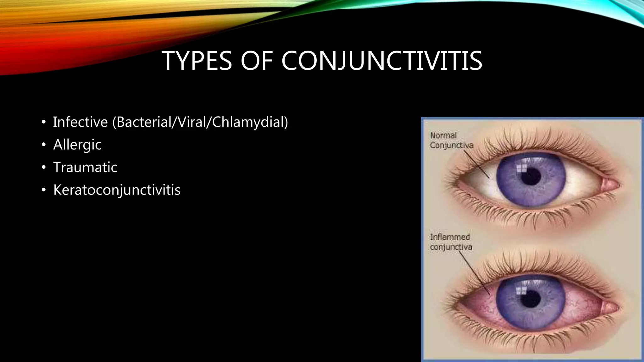 TYPES OF CONJUNCTIVITIS
• Infective (Bacterial/Viral/Chlamydial)
• Allergic
• Traumatic
• Keratoconjunctivitis
 