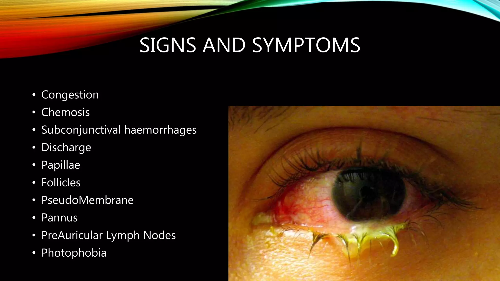SIGNS AND SYMPTOMS
• Congestion
• Chemosis
• Subconjunctival haemorrhages
• Discharge
• Papillae
• Follicles
• PseudoMembrane
• Pannus
• PreAuricular Lymph Nodes
• Photophobia
 