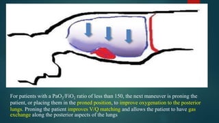 Management of covid 19(ards) | PPTX