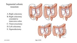 management of Colorectal cancer Ahmed.pptx