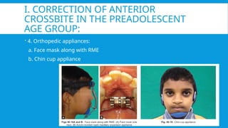 Crossbite Mask ORTHODONTIC Management of Crossbite.pptx