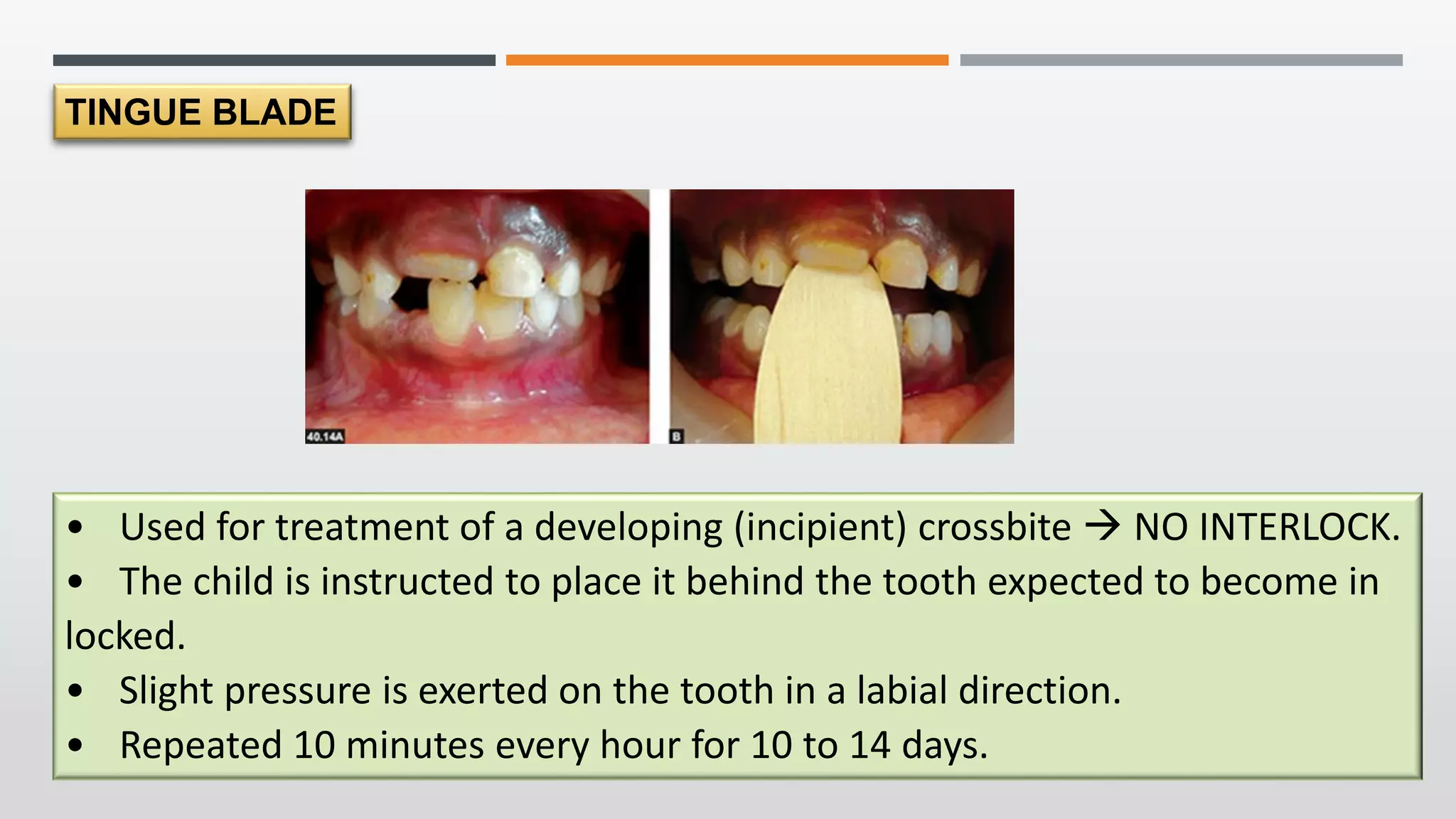 management-of-crossbite-in-mixed-dentition-pdf