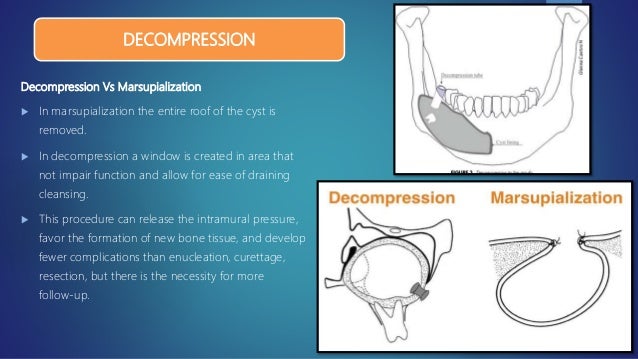 Management Of Cyst