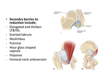Labrum Hour Management of Develpmental Dysplasia of the Hip | PPTX