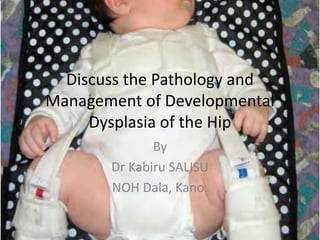 Discuss the Pathology and
Management of Developmental
Dysplasia of the Hip
By
Dr Kabiru SALISU
NOH Dala, Kano.
 