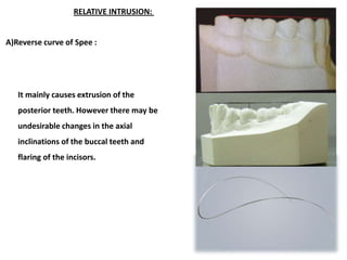 Management of Deep Bite _ Dr. Nabil Al-Zubair | PDF