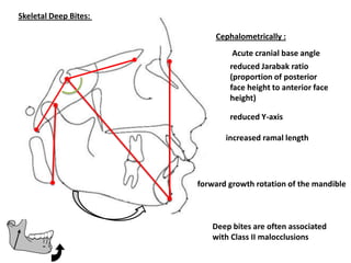 Skeletal Deep Bites:

                           Cephalometrically :
                                Acute cranial base an...