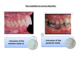 DIAGNOSTIC CONSIDERATIONS IN MANAGEMENT OF DEEP BITE




  1)Soft tissue considerations

   2)Dental considerations :

   ...