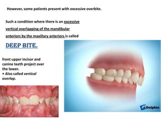 However, some patients present with excessive overbite.


  Such a condition where there is an excessive
  vertical overla...