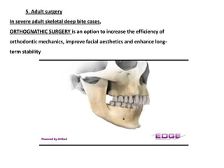Surgical options include:
mandibular advancement, maxillary surgery and
sub-apical osteotomy.




        mandibular advan...