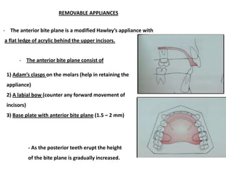 The anterior bite plane
 