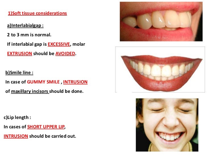 Management of Deep Bite _ Dr. Nabil AlZubair