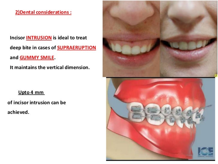 Management of Deep Bite _ Dr. Nabil AlZubair