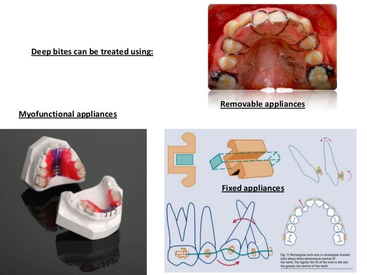 Management of Deep Bite _ Dr. Nabil AlZubair