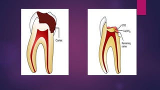 DIRECT PULP CAPPING
Procedure that involves the placement of biocompatible material
over the site of pulp exposure to main...