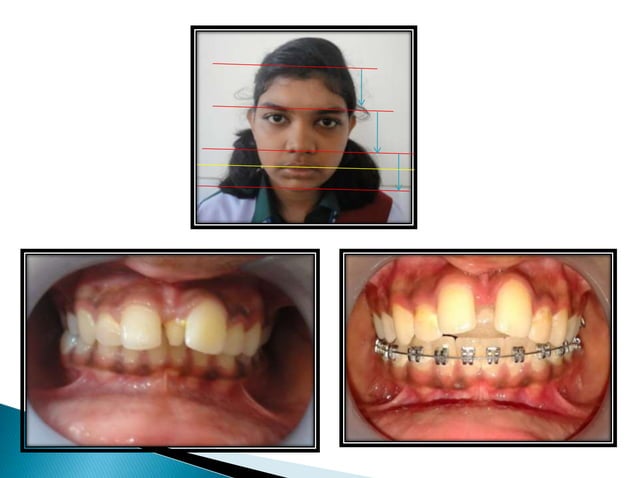 Management of deep overbite | PPTX | Dental Health | Diseases and ...