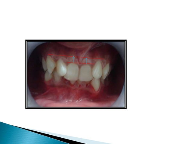 Management of deep overbite | PPTX | Dental Health | Diseases and ...
