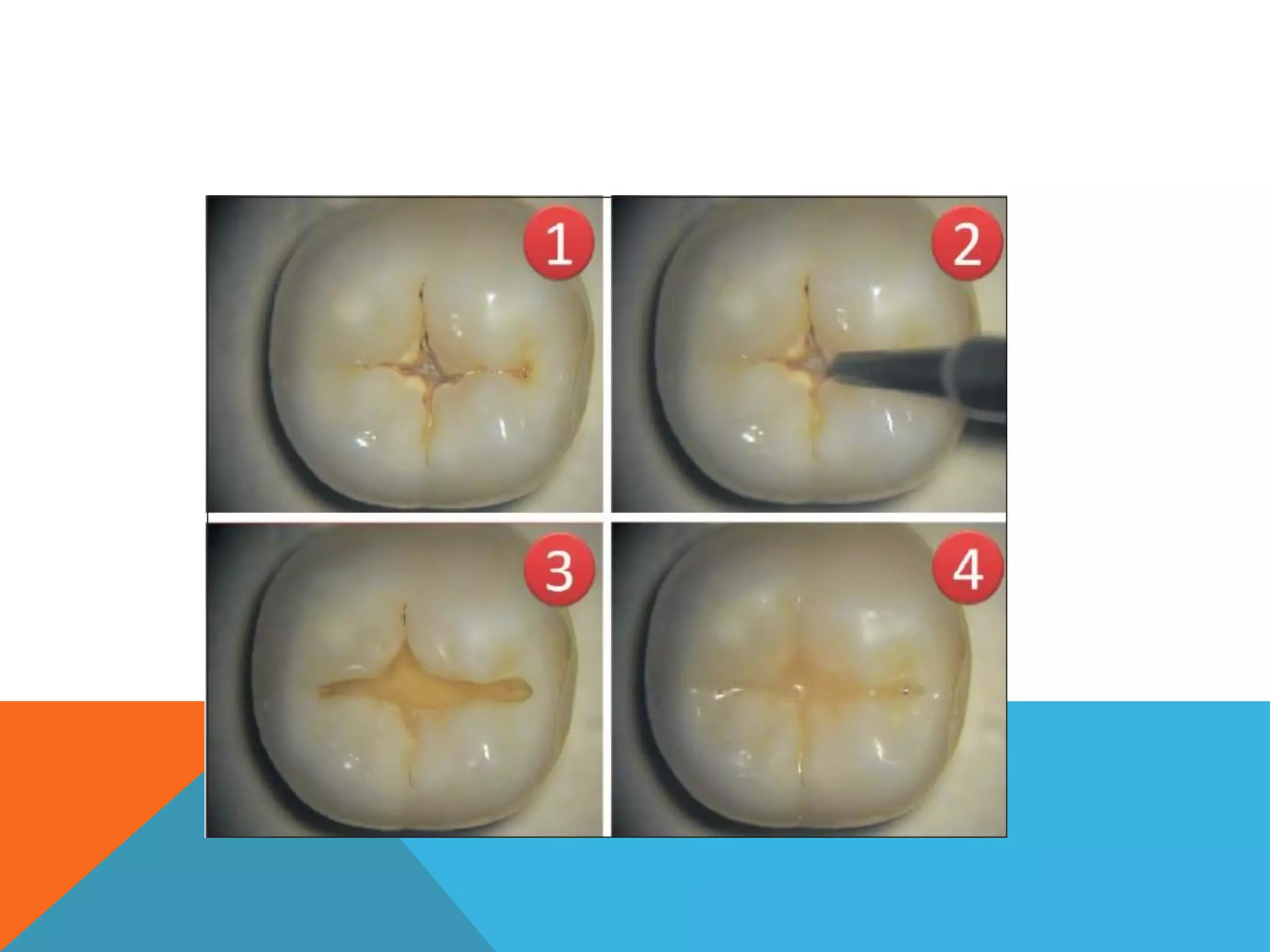 Management of dental caries | PDF