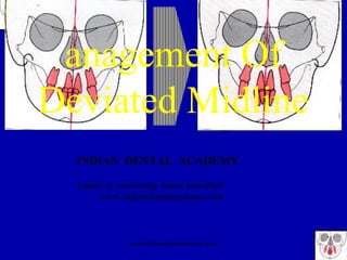 anagement Of
Deviated Midline
INDIAN DENTAL ACADEMY
Leader in continuing dental education
www.indiandentalacademy.com
www.indiandentalacademy.com
 