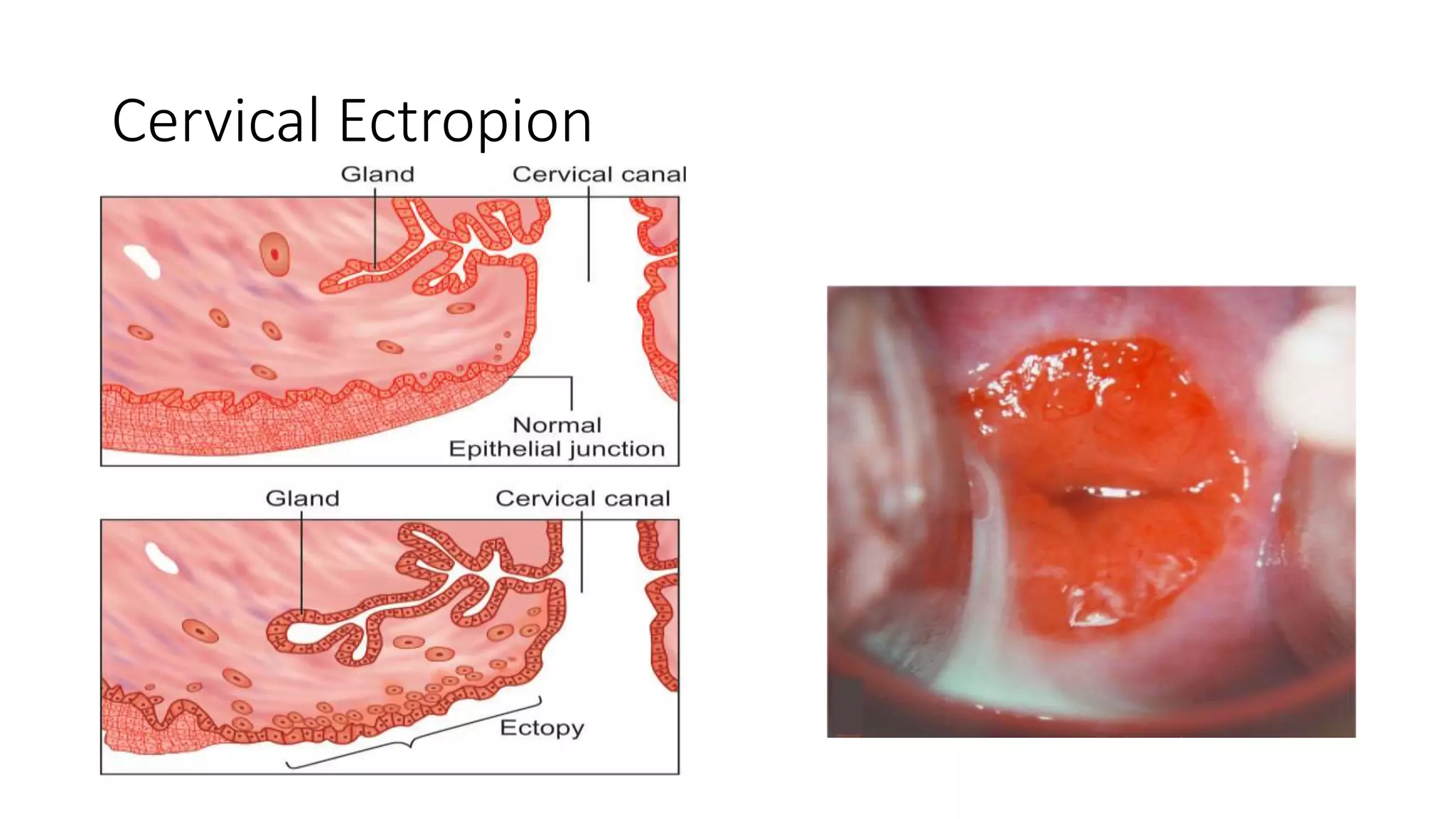 Management of diseases of cervix | PPTX | Sexual Conditions | Sexual Health