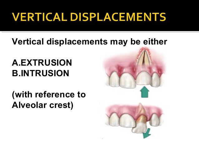 Causes Of Tooth Displacement , Avulsed Tooth – NFHQWP