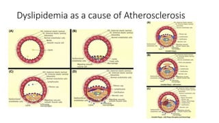 Dyslipidemia as a cause of Atherosclerosis
 
