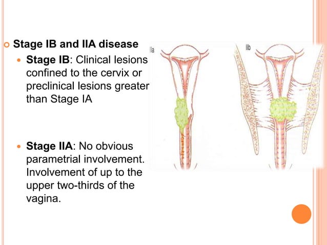 Management of Early Stage Carcinoma Cervix | PPTX | Cancer | Diseases ...