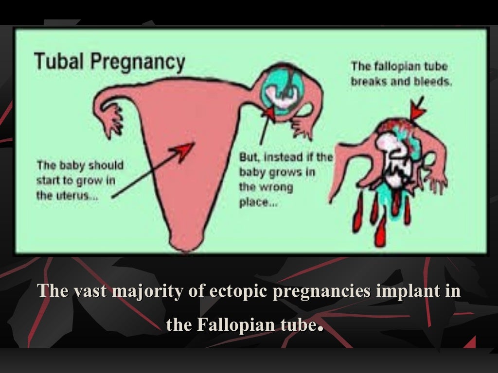 Management of ectopic pregnancy