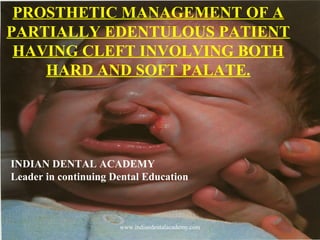PROSTHETIC MANAGEMENT OF A
PARTIALLY EDENTULOUS PATIENT
HAVING CLEFT INVOLVING BOTH
HARD AND SOFT PALATE.
INDIAN DENTAL ACADEMY
Leader in continuing Dental Education
www.indiandentalacademy.com
 