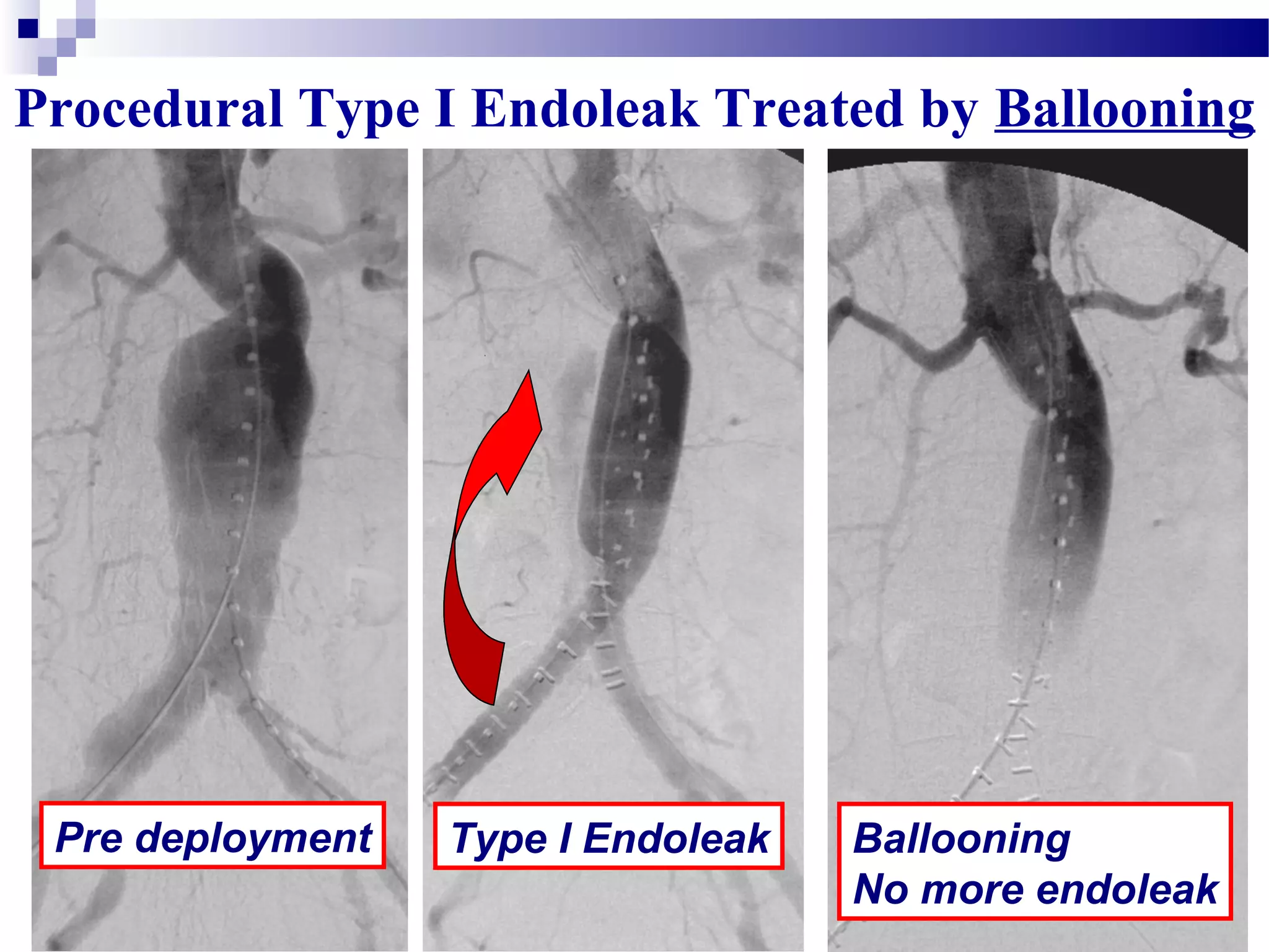 Procedural Type I Endoleak Treated by Ballooning
Pre deployment Type I Endoleak Ballooning
No more endoleak
 