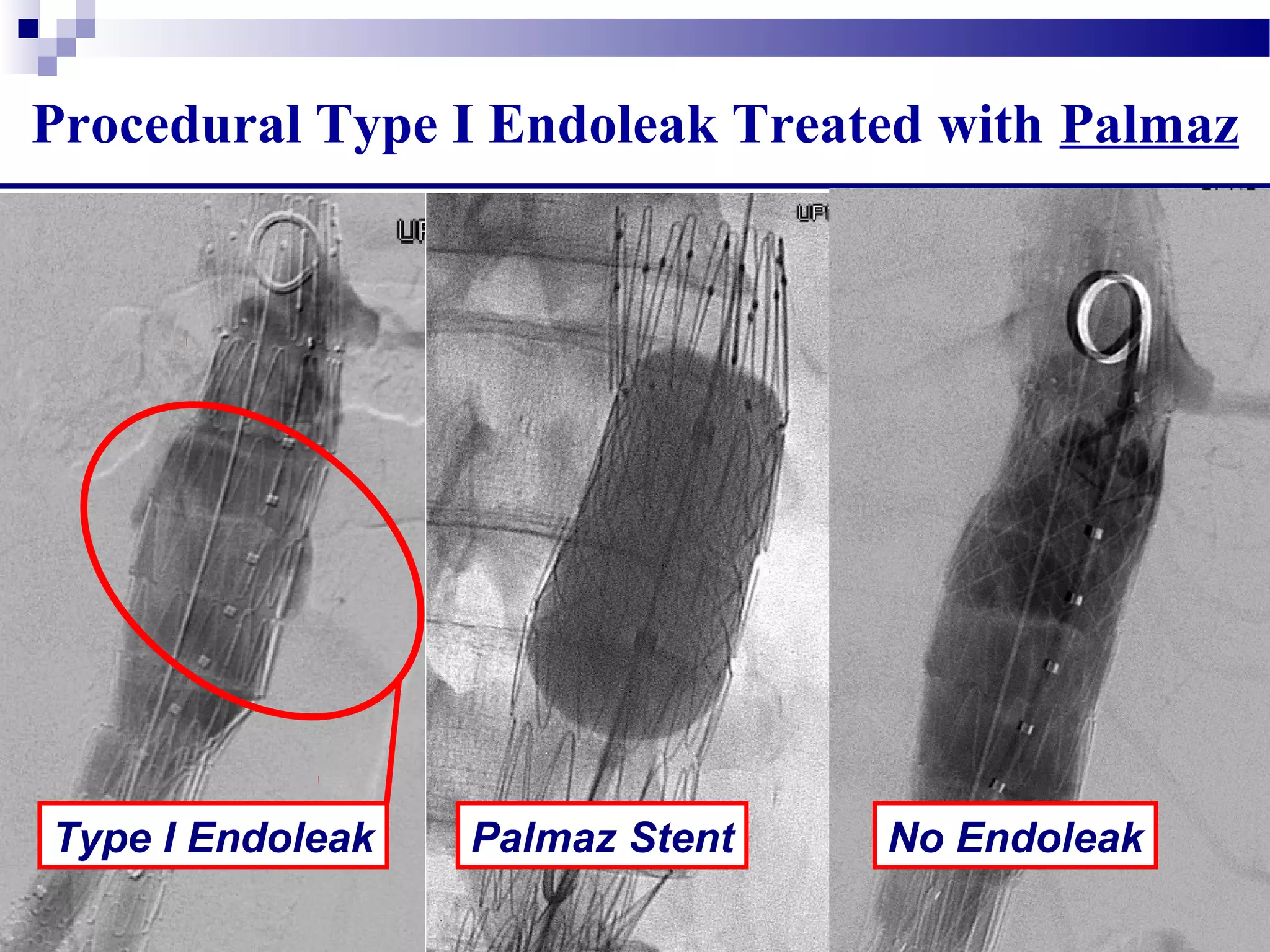 Procedural Type I Endoleak Treated with Palmaz
Type I Endoleak Palmaz Stent No Endoleak
 