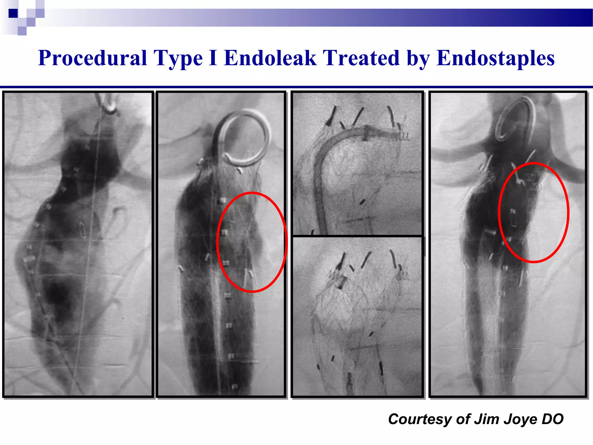 Procedural Type I Endoleak Treated by Endostaples
Courtesy of Jim Joye DO
 