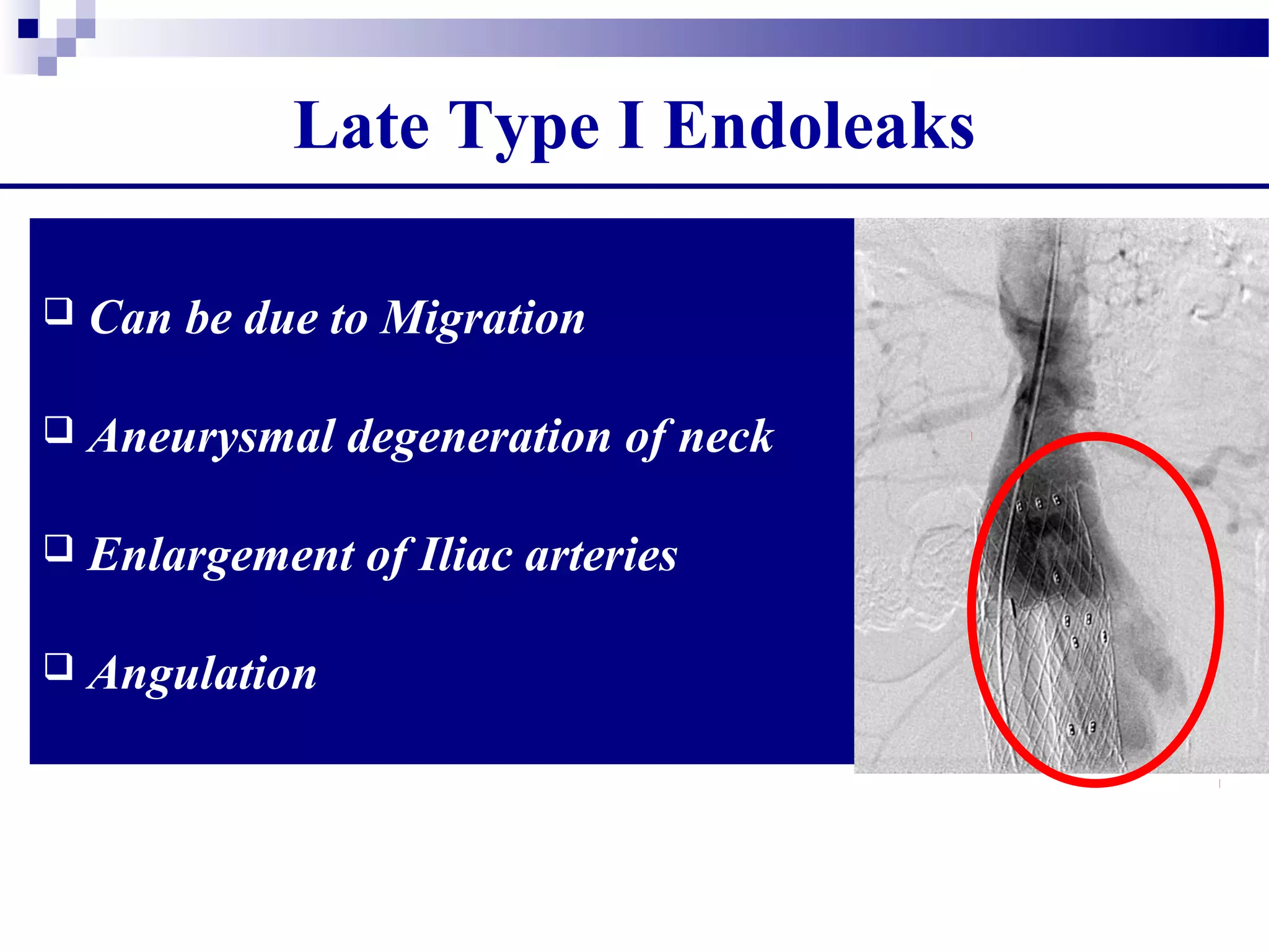Late Type I Endoleaks
 Can be due to Migration
 Aneurysmal degeneration of neck
 Enlargement of Iliac arteries
 Angulation
 