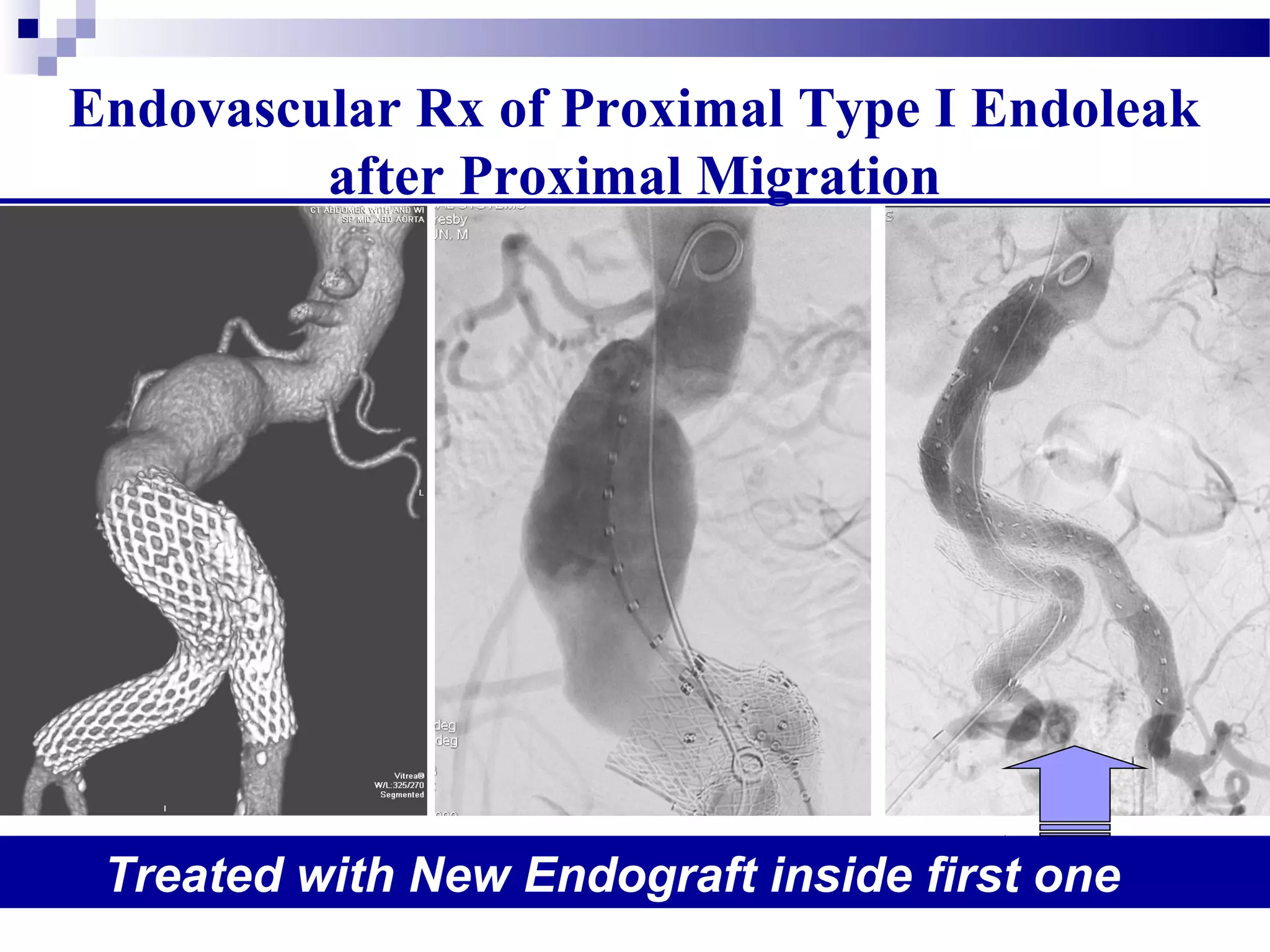 Treated with New Endograft inside first one
Endovascular Rx of Proximal Type I Endoleak
after Proximal Migration
 