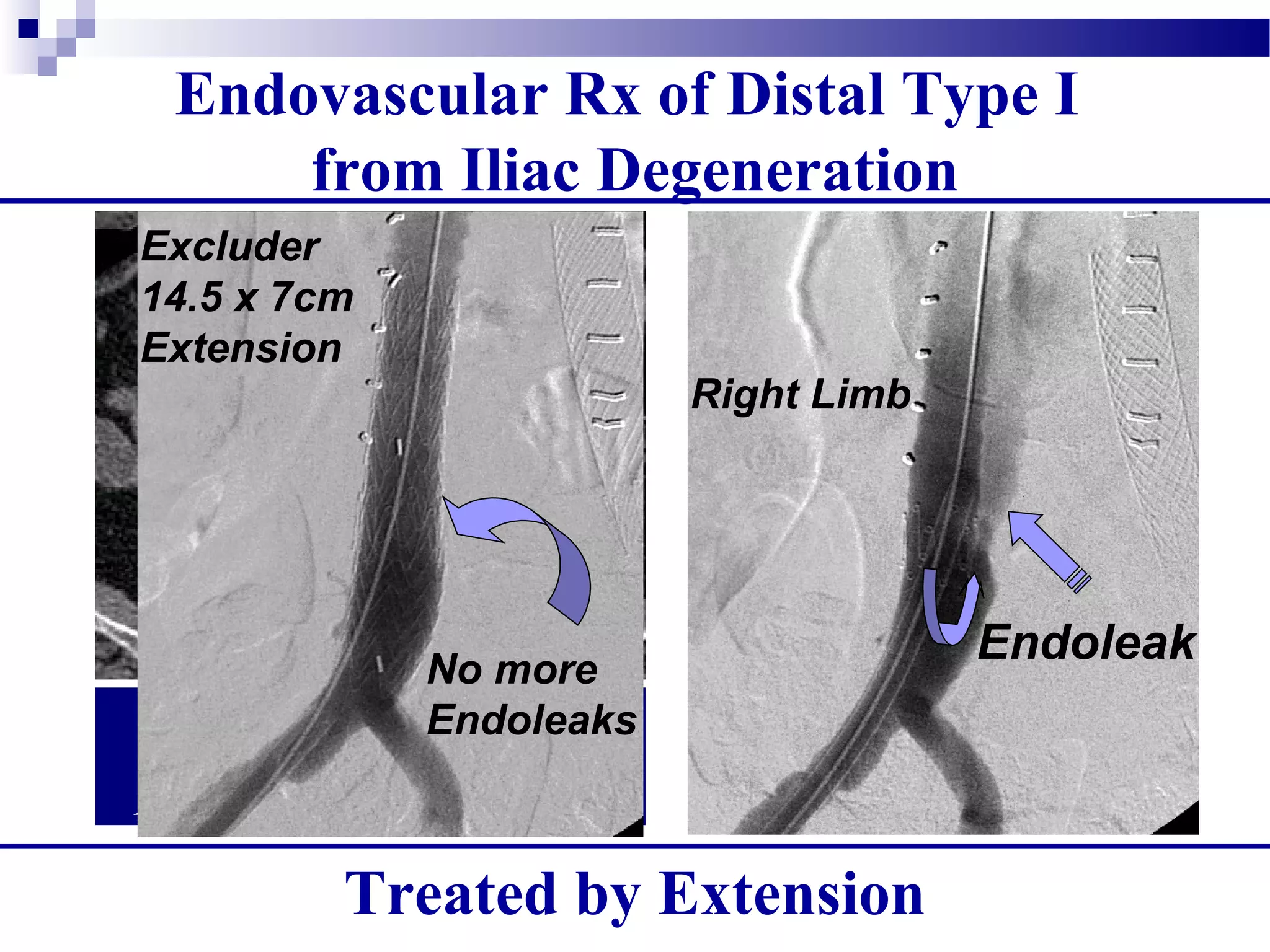Endovascular Rx of Distal Type I
from Iliac Degeneration
7 years post Ancure:
Distal Type I Endoleak
Right Limb
Endoleak
Excluder
14.5 x 7cm
Extension
No more
Endoleaks
Treated by Extension
 
