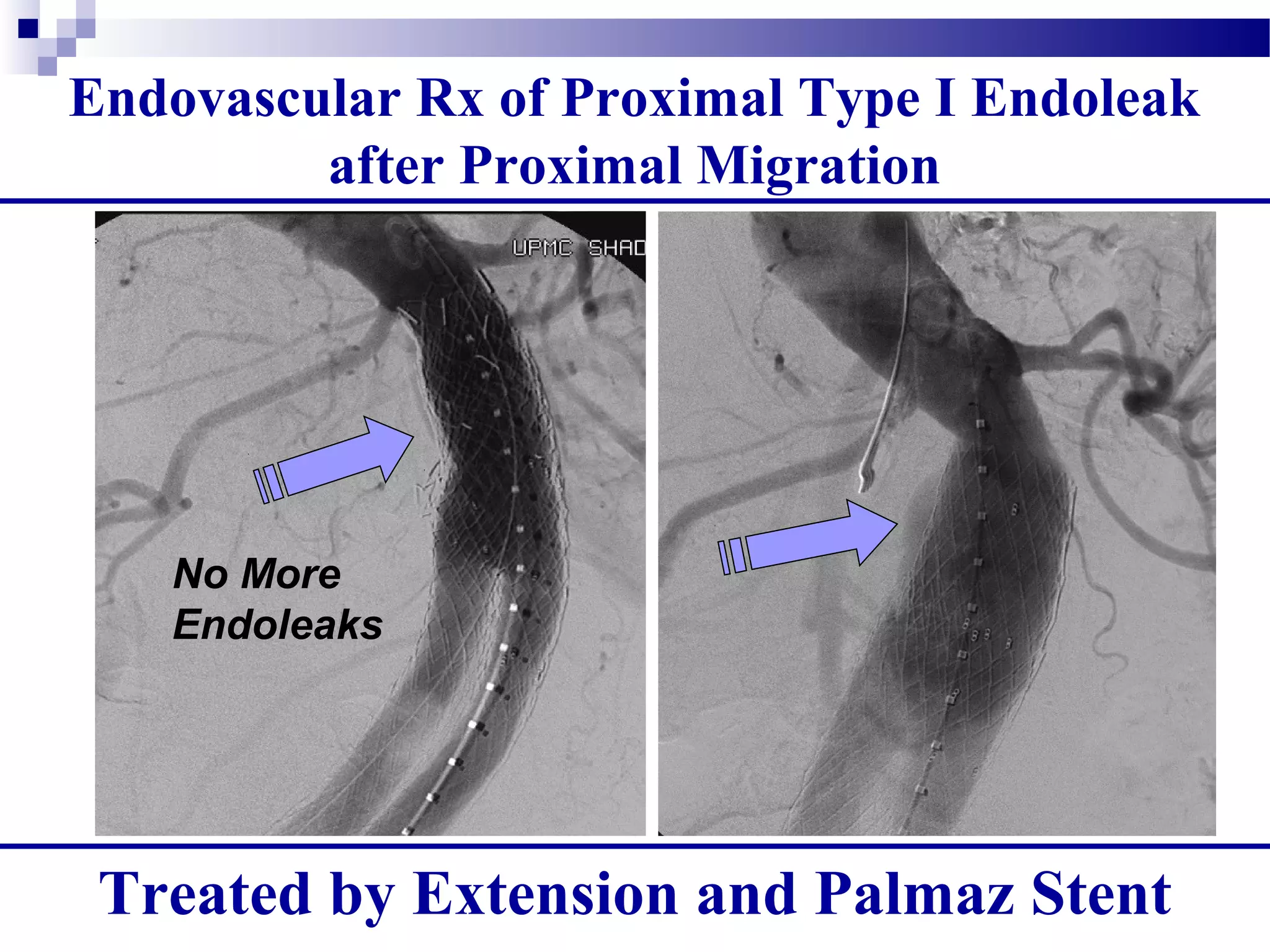 Endovascular Rx of Proximal Type I Endoleak
after Proximal Migration
3 years post AneuRx:
Migration and Proximal
Type I
No More
Endoleaks
Treated by Extension and Palmaz Stent
 