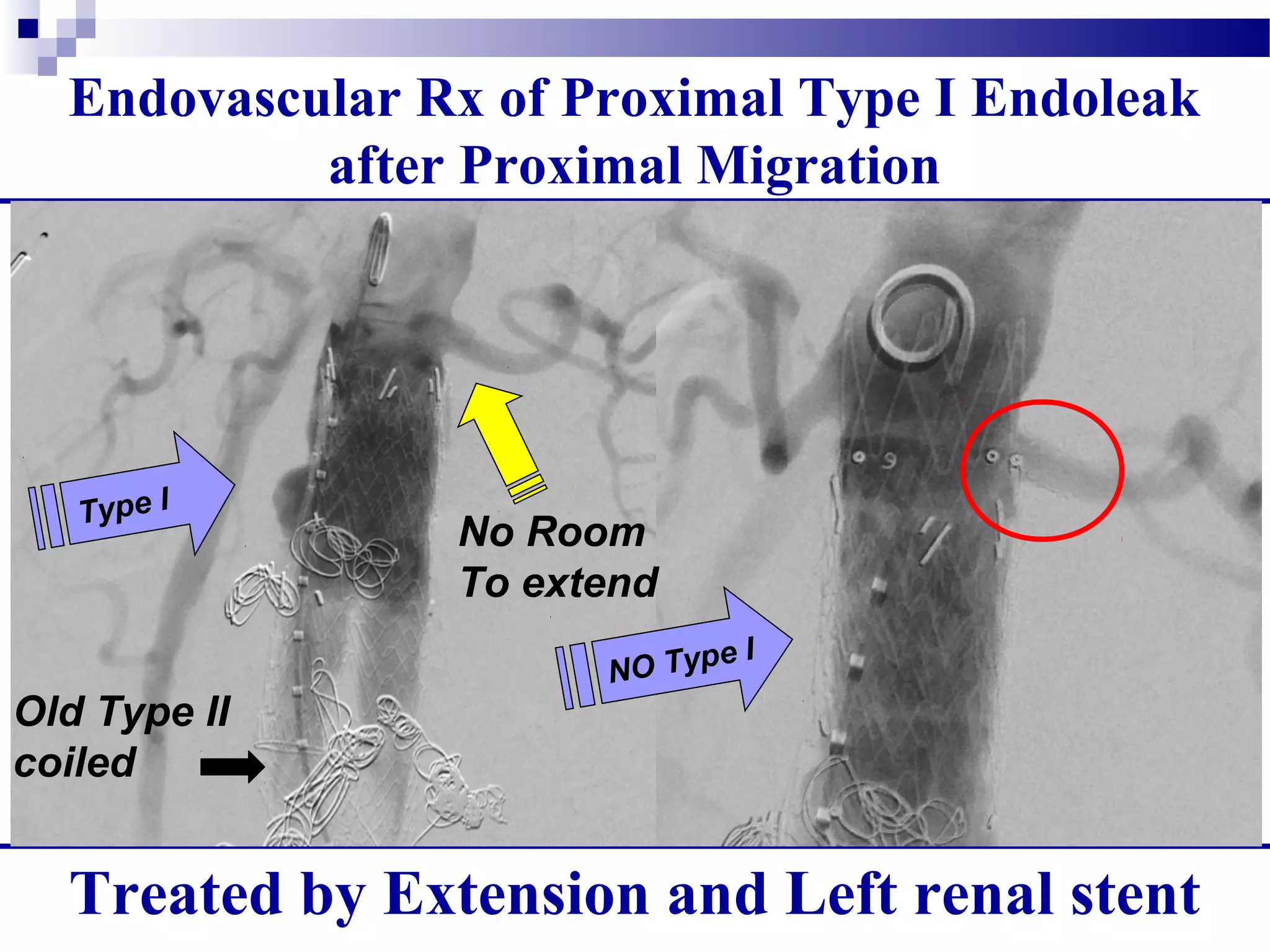 Endovascular Rx of Proximal Type I Endoleak
after Proximal Migration
Treated by Extension and Left renal stent
Type I
Old Type II
coiled
NO Type I
No Room
To extend
 