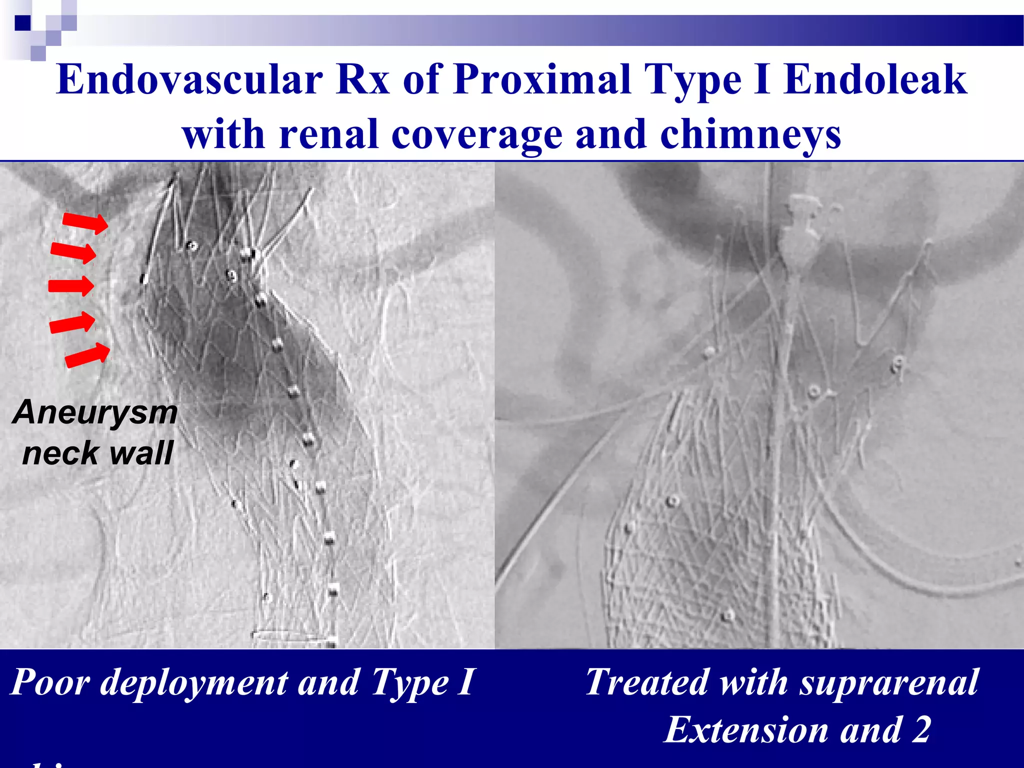 Endovascular Rx of Proximal Type I Endoleak
with renal coverage and chimneys
Aneurysm
neck wall
Poor deployment and Type I Treated with suprarenal
Extension and 2
Failed
Extension
Palmaz
Staples
 