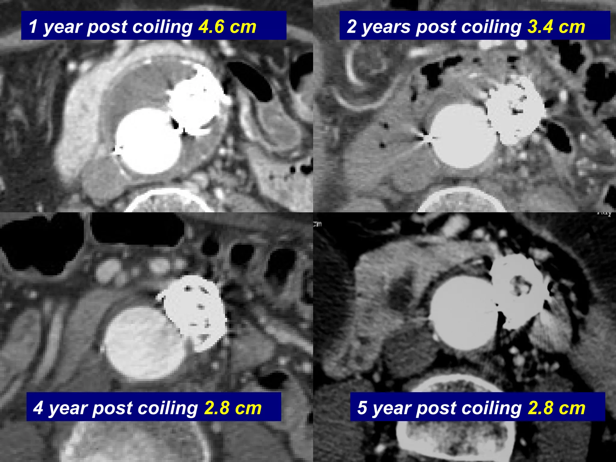 Coiling of Distal Type I
1 year post coiling 4.6 cm 2 years post coiling 3.4 cm
5 year post coiling 2.8 cm4 year post coiling 2.8 cm
 