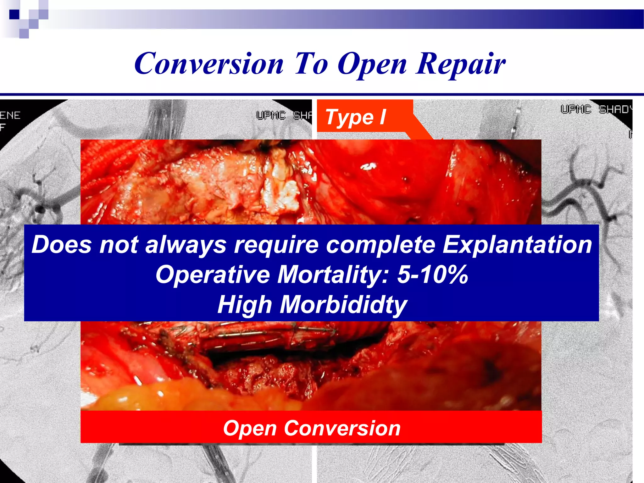 Type I
Open Conversion
Does not always require complete Explantation
Operative Mortality: 5-10%
High Morbididty
Conversion To Open Repair
 