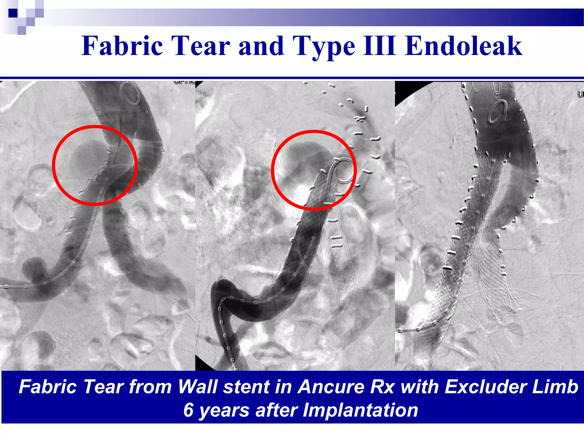 Fabric Tear and Type III Endoleak
Fabric Tear from Wall stent in Ancure Rx with Excluder Limb
6 years after Implantation
 