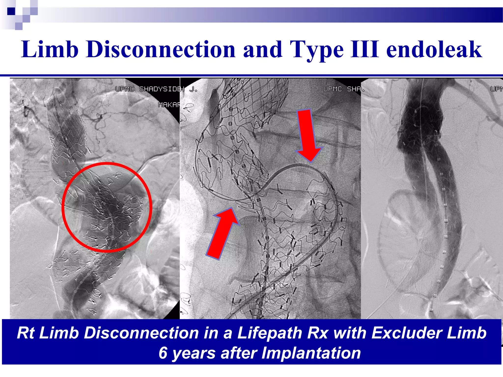 Limb Disconnection and Type III endoleak
Rt Limb Disconnection in a Lifepath Rx with Excluder Limb
6 years after Implantation
 